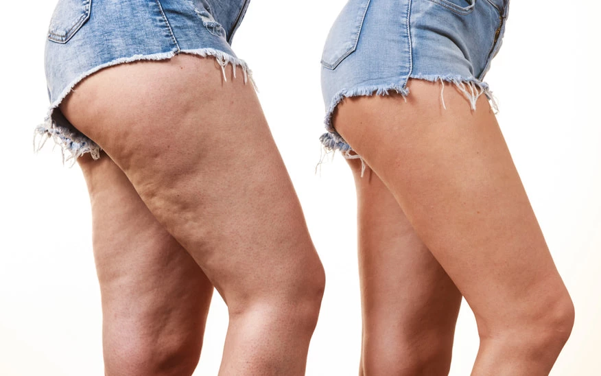 La cellulite - En Corps Mieux - Centre de soin minceur à Laval